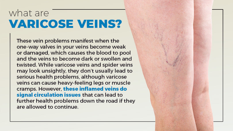 Varicose Veins In Your 20s Causes Symptoms And Natural Remedies 2022