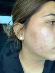 girl after acne and scars with improved skin