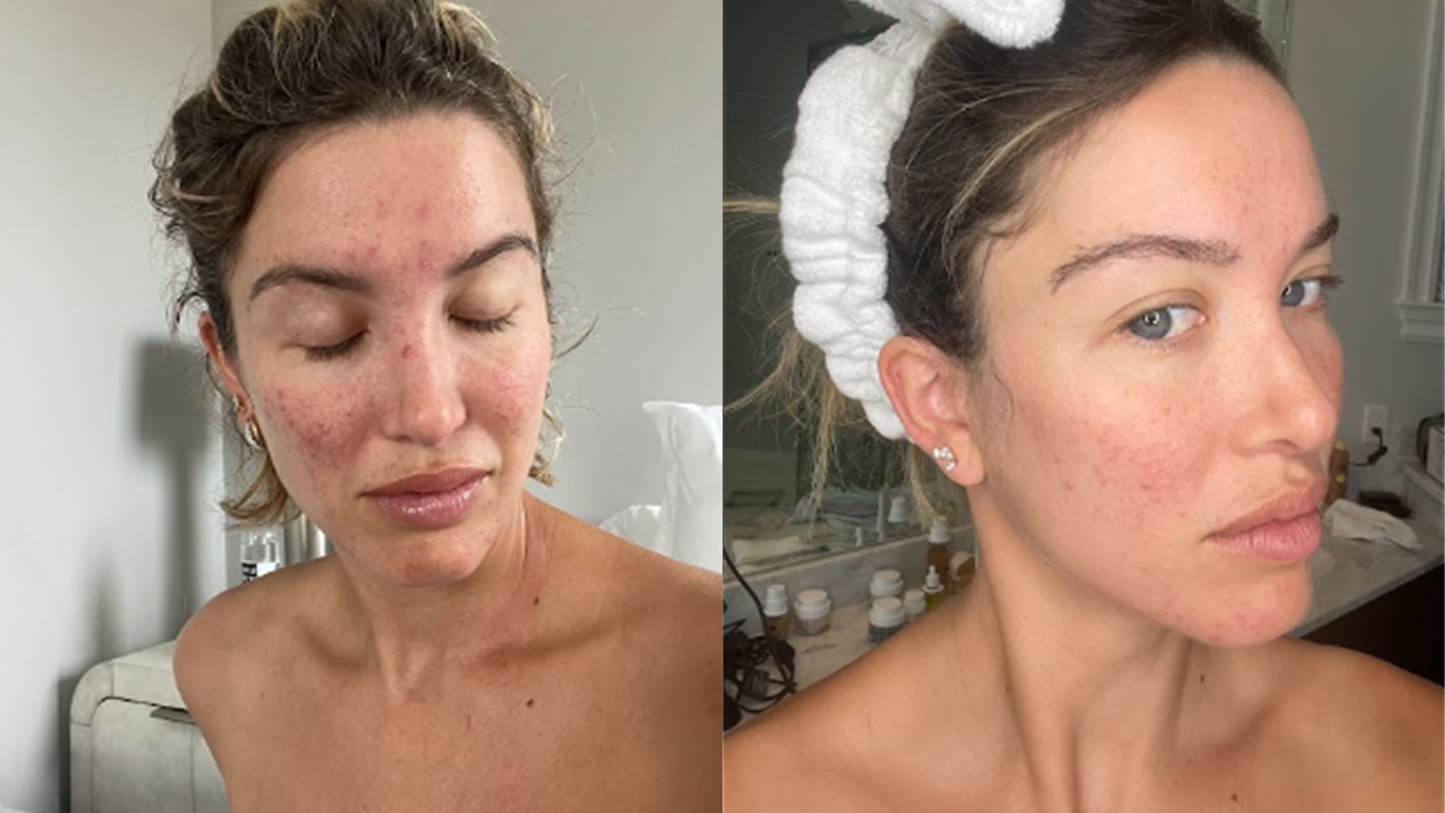 red light therapy face before and after