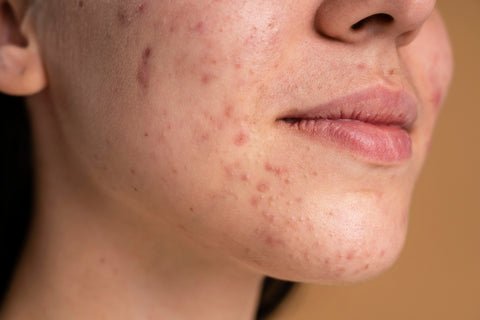 Women with acne on her face