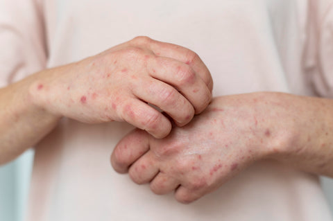 Person with skin rashes