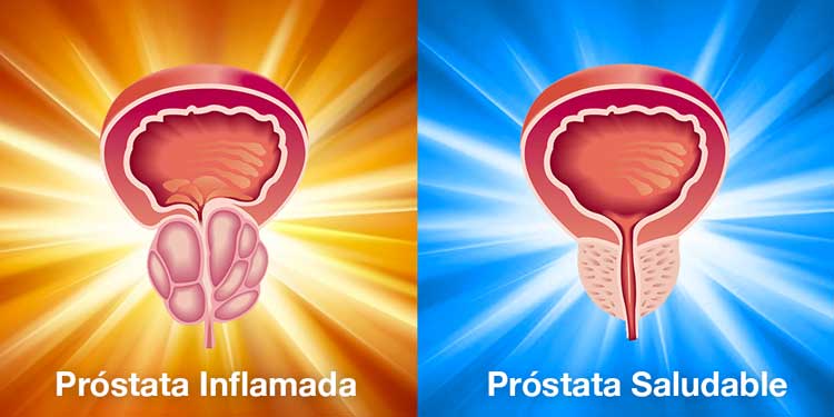 La Solución A La Próstata Inflamada Prostakin 0006