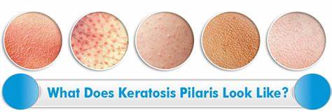 keratosis pilaris