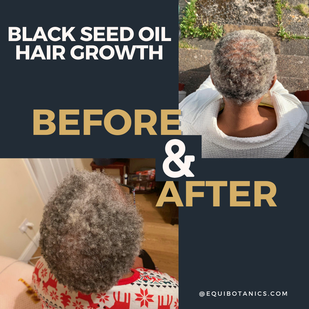 Black Seed Oil Hair Growth Before And After – Equi Botanics