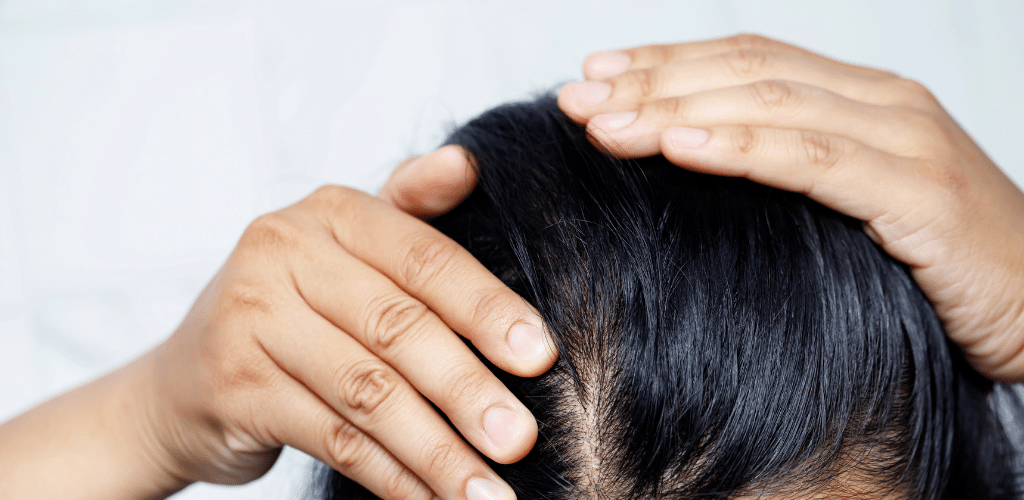 Scalp dermatitis Signs and symptoms of skin inflammation
