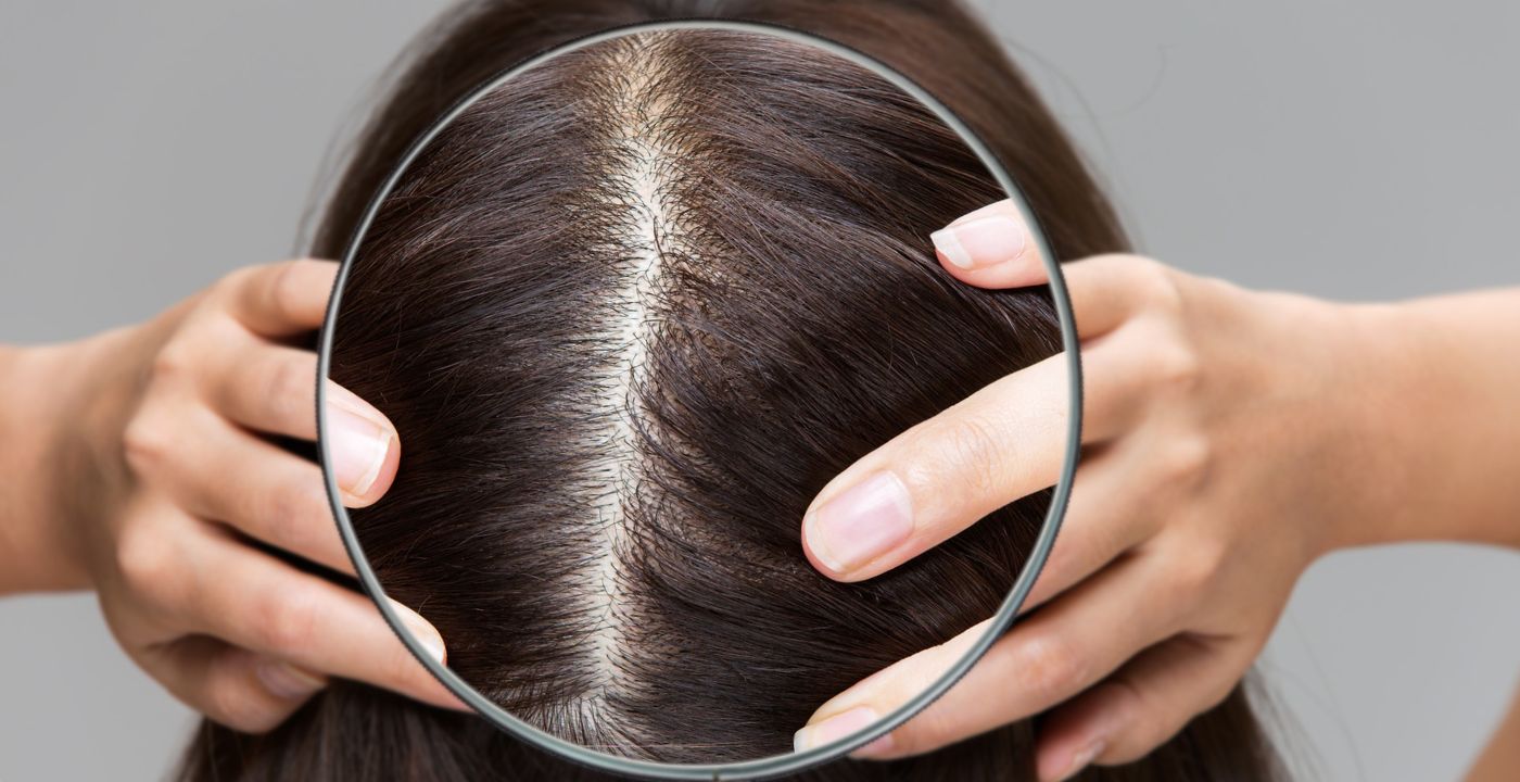 Battling with thinning hair Heres top 5 ways that can help  Derma  Essentia