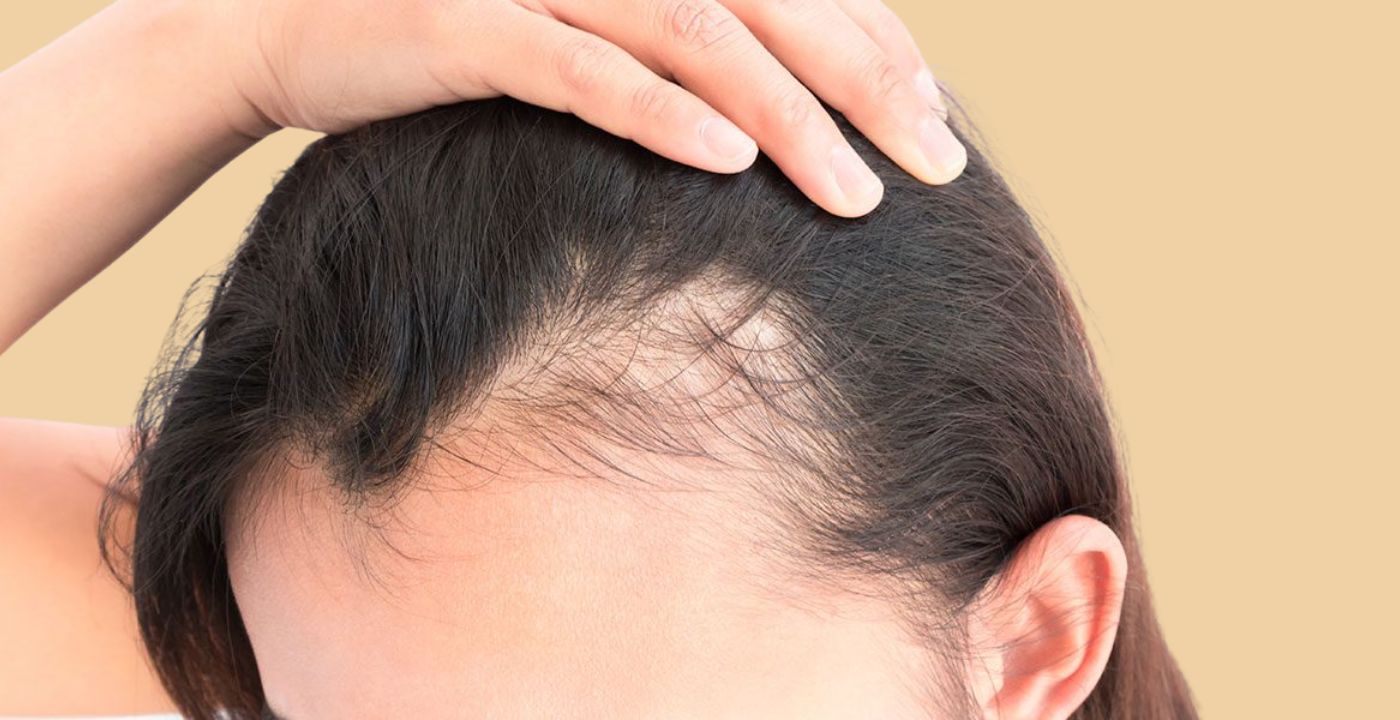 Receding Hairline In Women Causes  Helpful Treatments