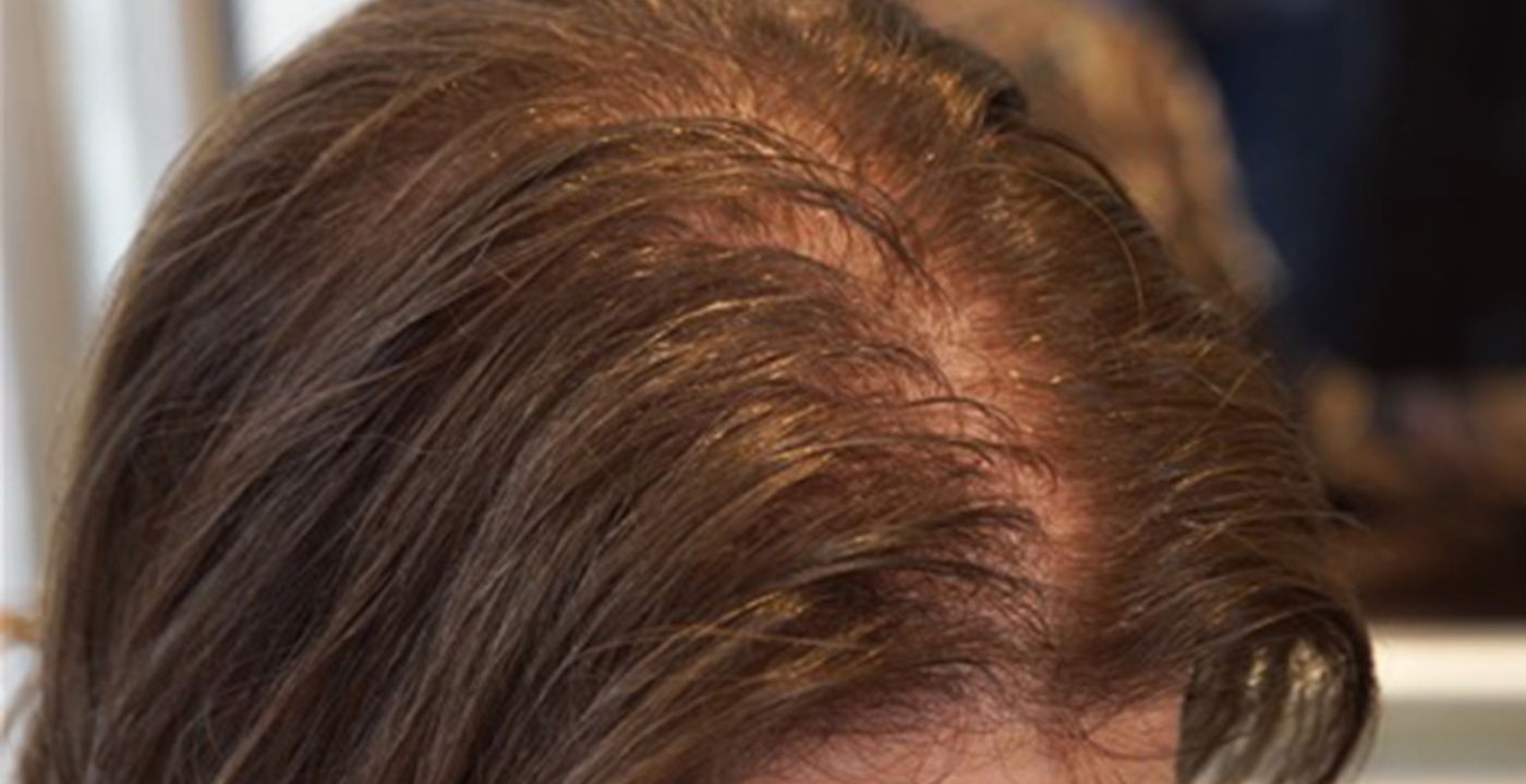 Causes and Risk Factors for Androgenetic Alopecia  Everyday Health
