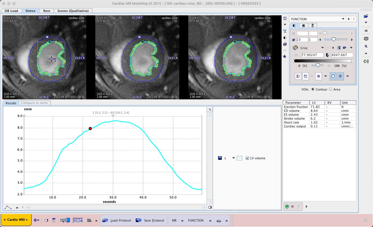 PCARDM Cardiac MR Analysis  (Remote)