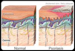 Psoriasis and how SOLBARI sun protective clothing can help