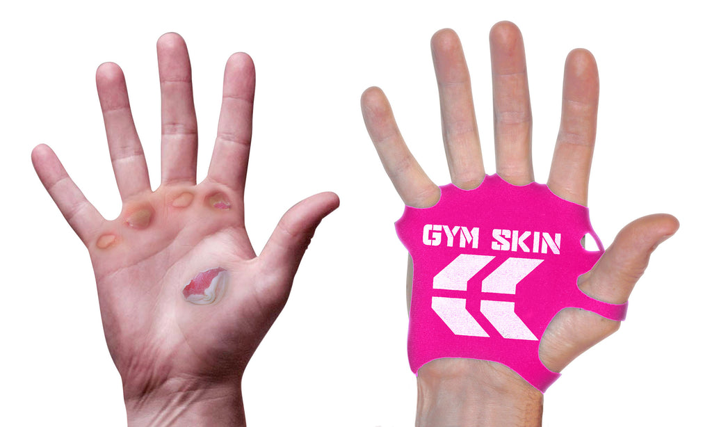 picture of two hands palms facing camera. one hand is extremely damaged and full of blisters, the other wearing a pink gym skin by STKR Concepts