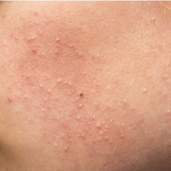 What is acne cosmetica treat it? – DERMALA