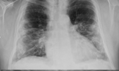 pulmonía por COVID-19