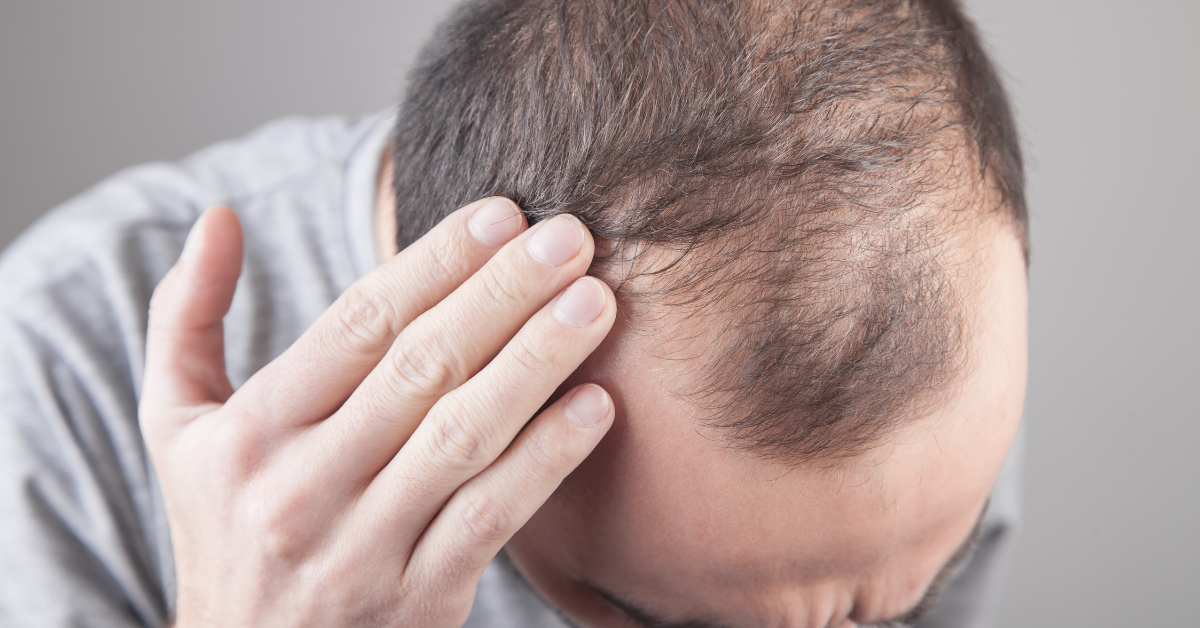 hair loss due to lack of biotin