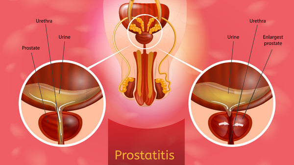 Prostatitis