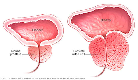 diagram of enlarged prostate compared to normal prostate