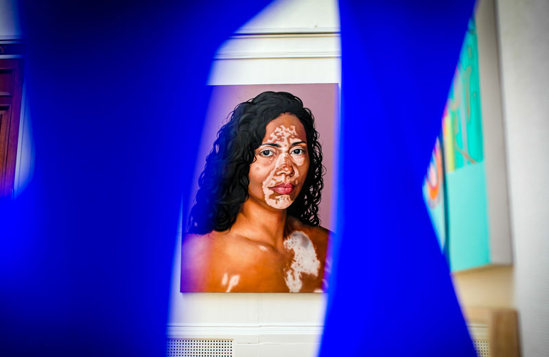 A painted portrait of a woman with vitiligo 