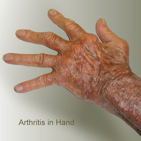 Arthritis Hands