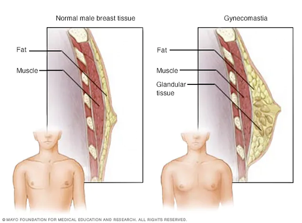 Fibrocystic Breasts and Gynecomastia in Men