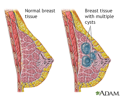 Thickened Breast Tissue - Estrogen Dominance Symptoms