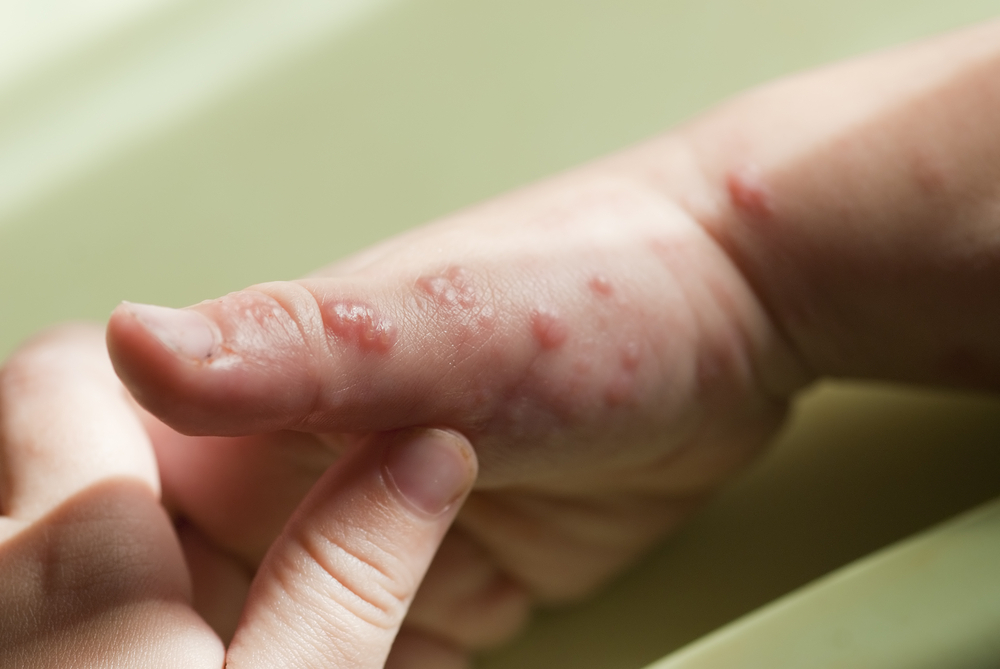 Care and Treatment for Kids with Shingles
