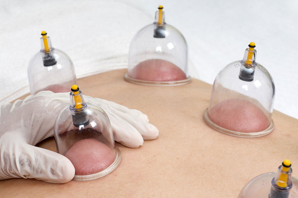 Benefits of cupping