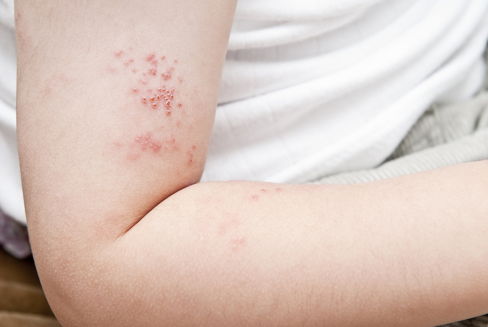 shingles rash