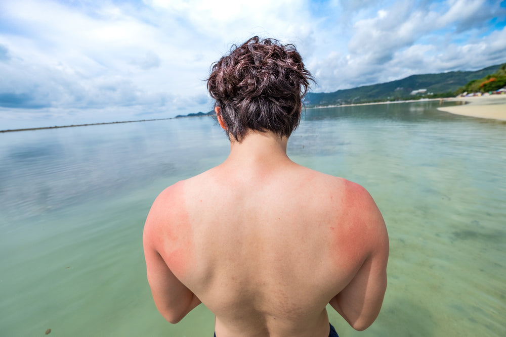 4 Natural Remedies to Treat Sunburn – Herb Affair