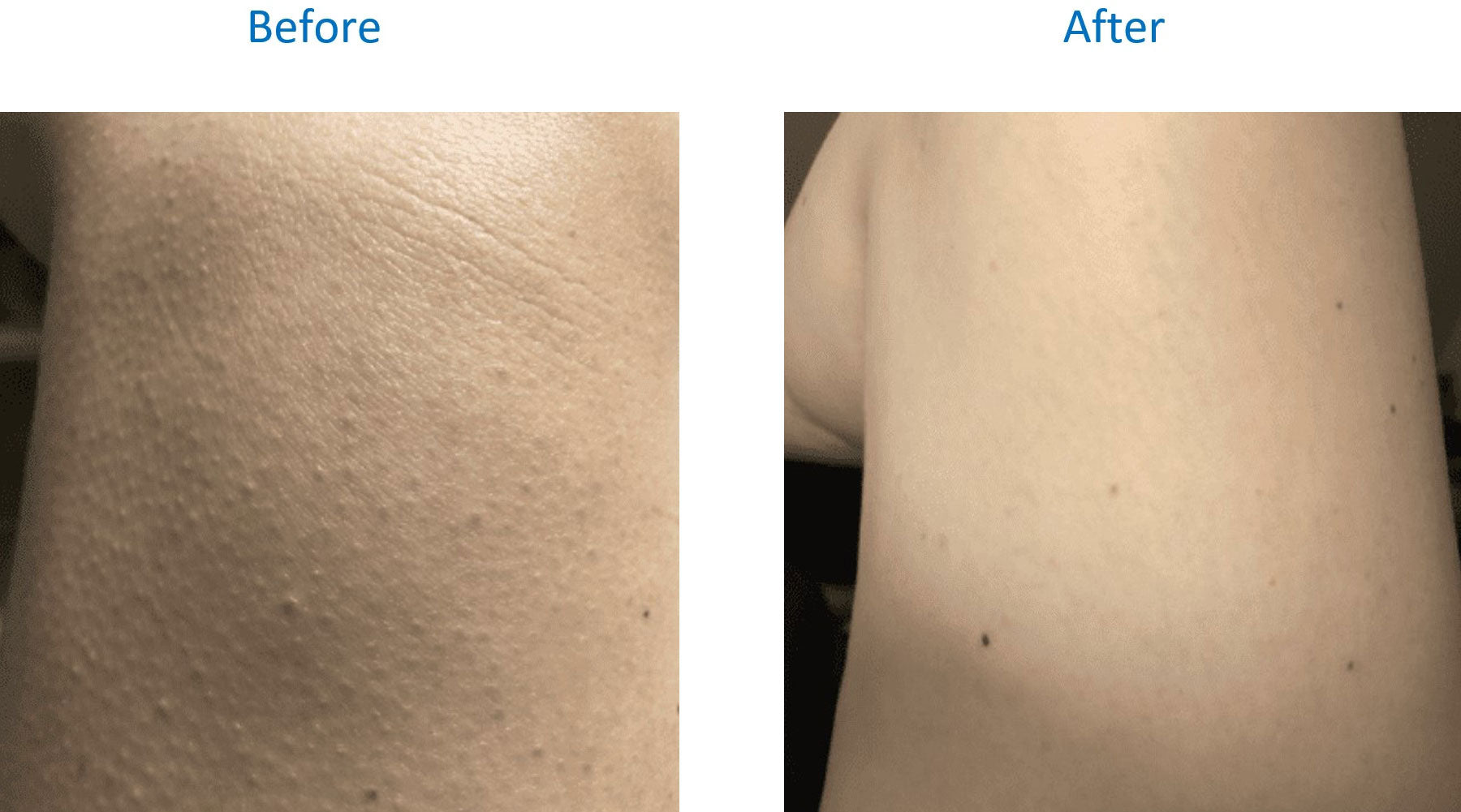 keratosis pilaris treatment before and after