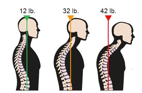 Forward Head Posture Neck Pain CerebralBody