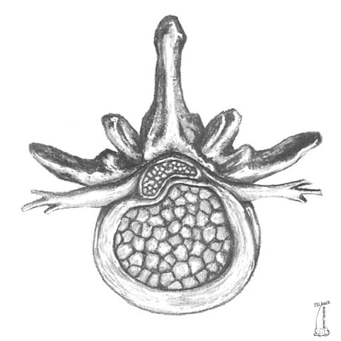 IVDD in Dogs - Type 2 IVDD - Bulging Intervertebral Disc