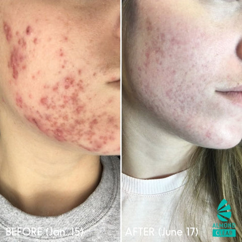 mandelic acid before and after for acne