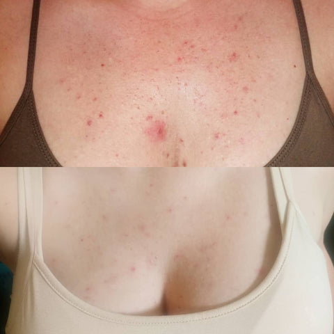 fungal acne before and after, chest, mandelic acid