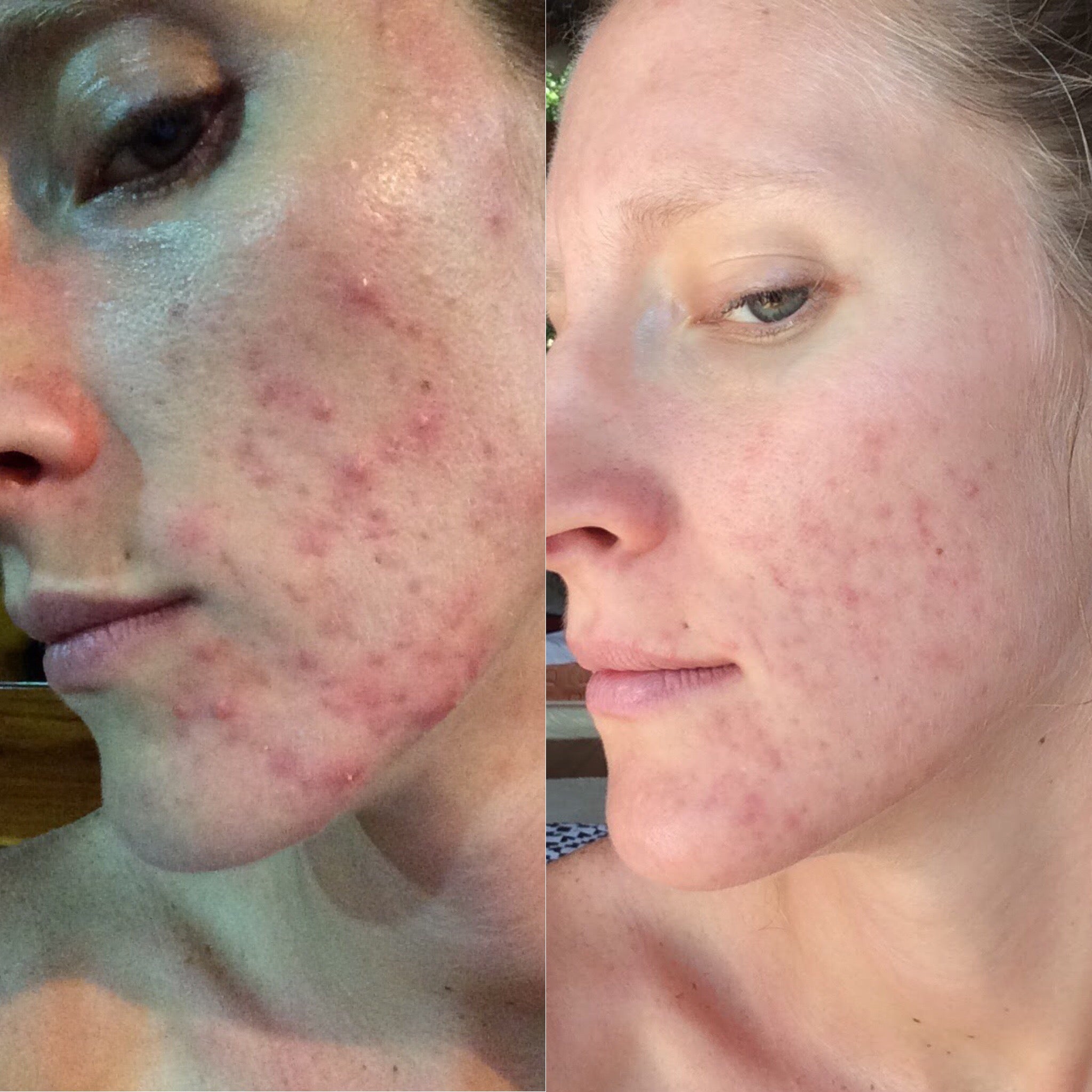 before and after mandelic acid for acne 