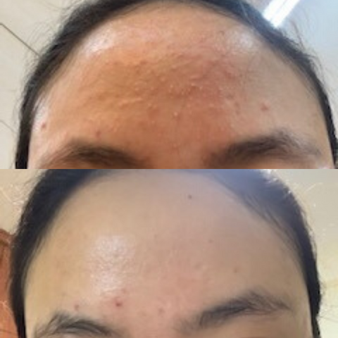 fungal acne before and after, forehead, mandelic acid serum 