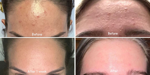 Fungal acne before and after Almond Clear- Fungal acne on forehead