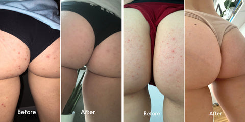 Fungal acne before and after Almond Clear- Fungal acne on butt