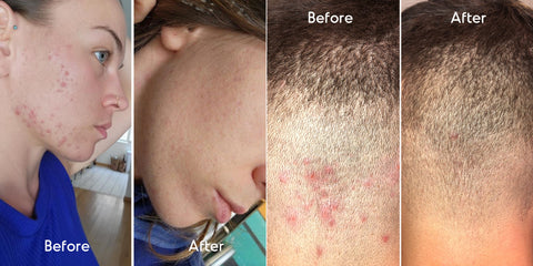 Fungal acne before and after- fungal acne on cheeks and scalp