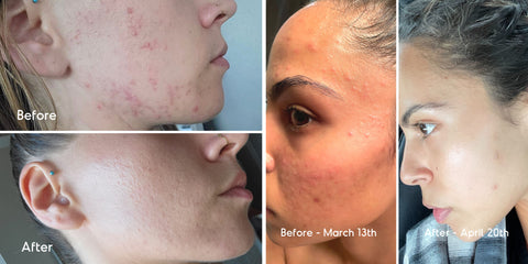 Fungal acne before and after Almond Clear - Fungal acne on cheeks