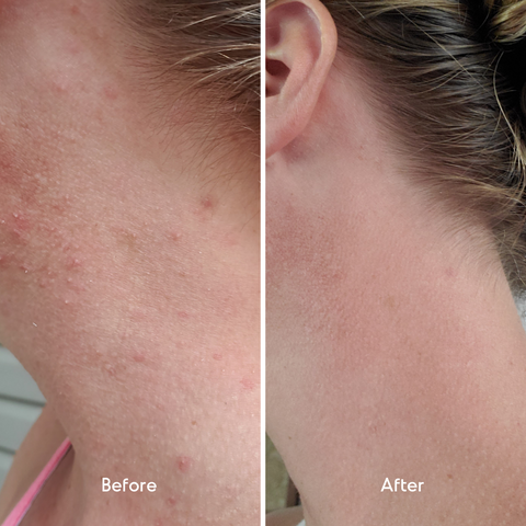 fungal ance before and after, neck, mandelic acid treatment
