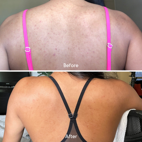 fungal acne before and after,  back, mandelic acid