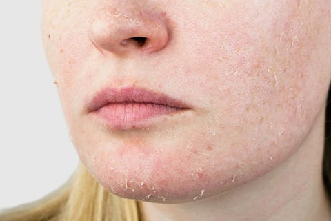 dry acne prone skin