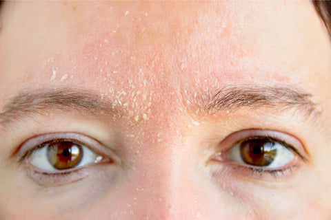dry acne prone skin