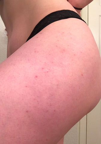 how do you get rid of keratosis pilaris naturally?