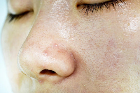 oily acne prone skin