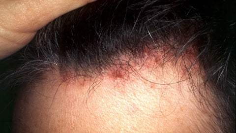 scalp folliculitis treatment