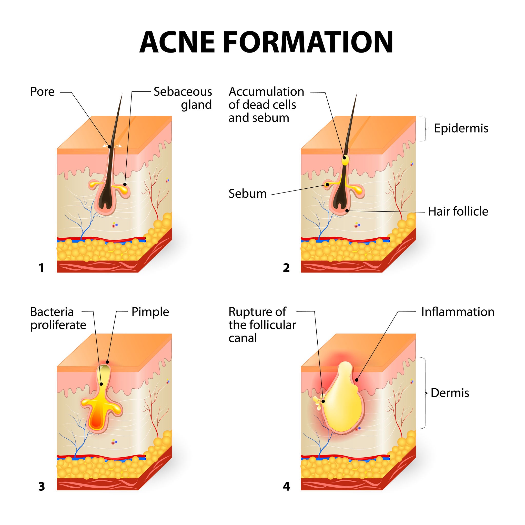 chart of acne formation