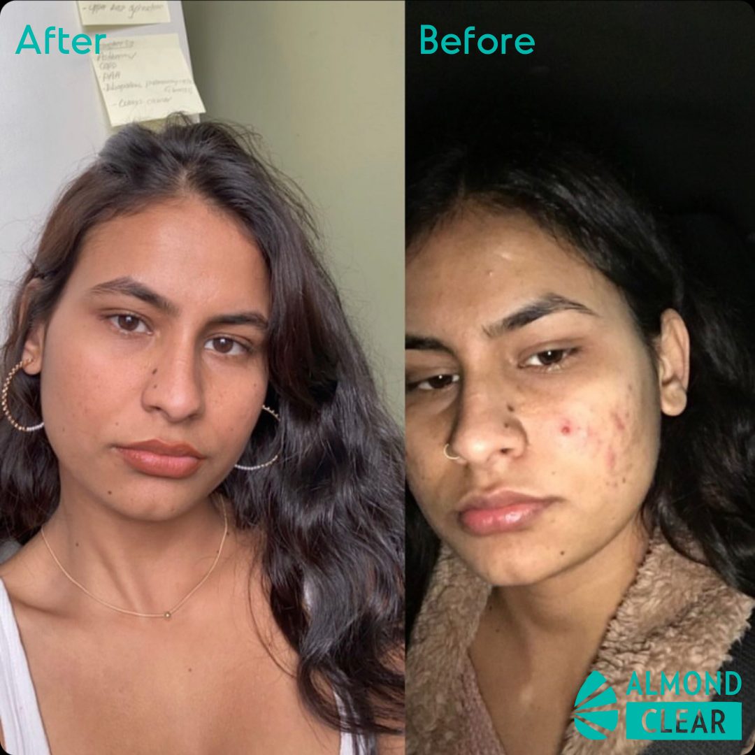 B&A] 3 Microneedling Treatments with the Dr. Pen : r/SkincareAddiction