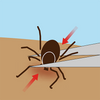 tick removal with TickEase fine tip end