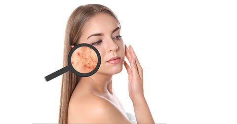 polycystic ovarian syndrome acne